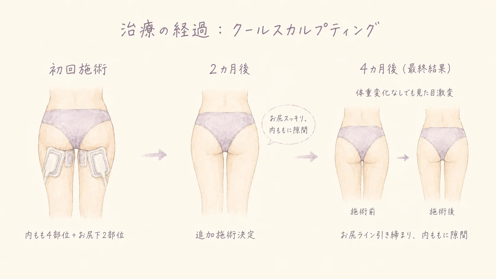 クールスカルプティング 治療の経過｜初回施術→2カ月後→4カ月後（最終結果）