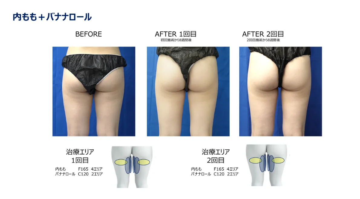 クールスカルプティング 施術前後の比較写真