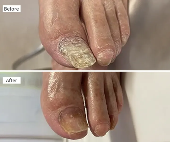 完全爪再生 症例 70代男性 分厚い爪 肥厚爪 Before/After