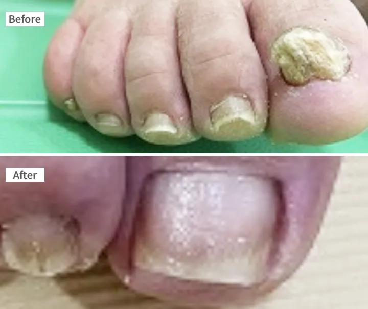 フットケア 症例 60代女性 爪白癬 Before/After