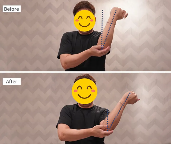体外衝撃波症例 40代男性 肩こり Before/After