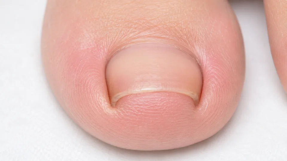 足の親指の爪の両端が内側に巻き込み、爪の角が両脇の皮膚に食い込んでいる巻き爪の状態(清潔な白背景でのクローズアップ)